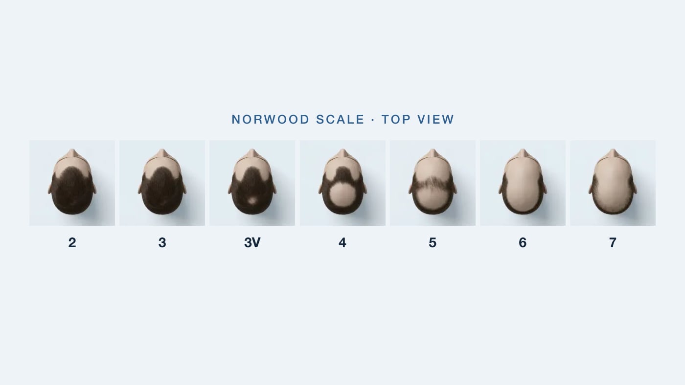 Norwood scale showing stages of male pattern hair loss