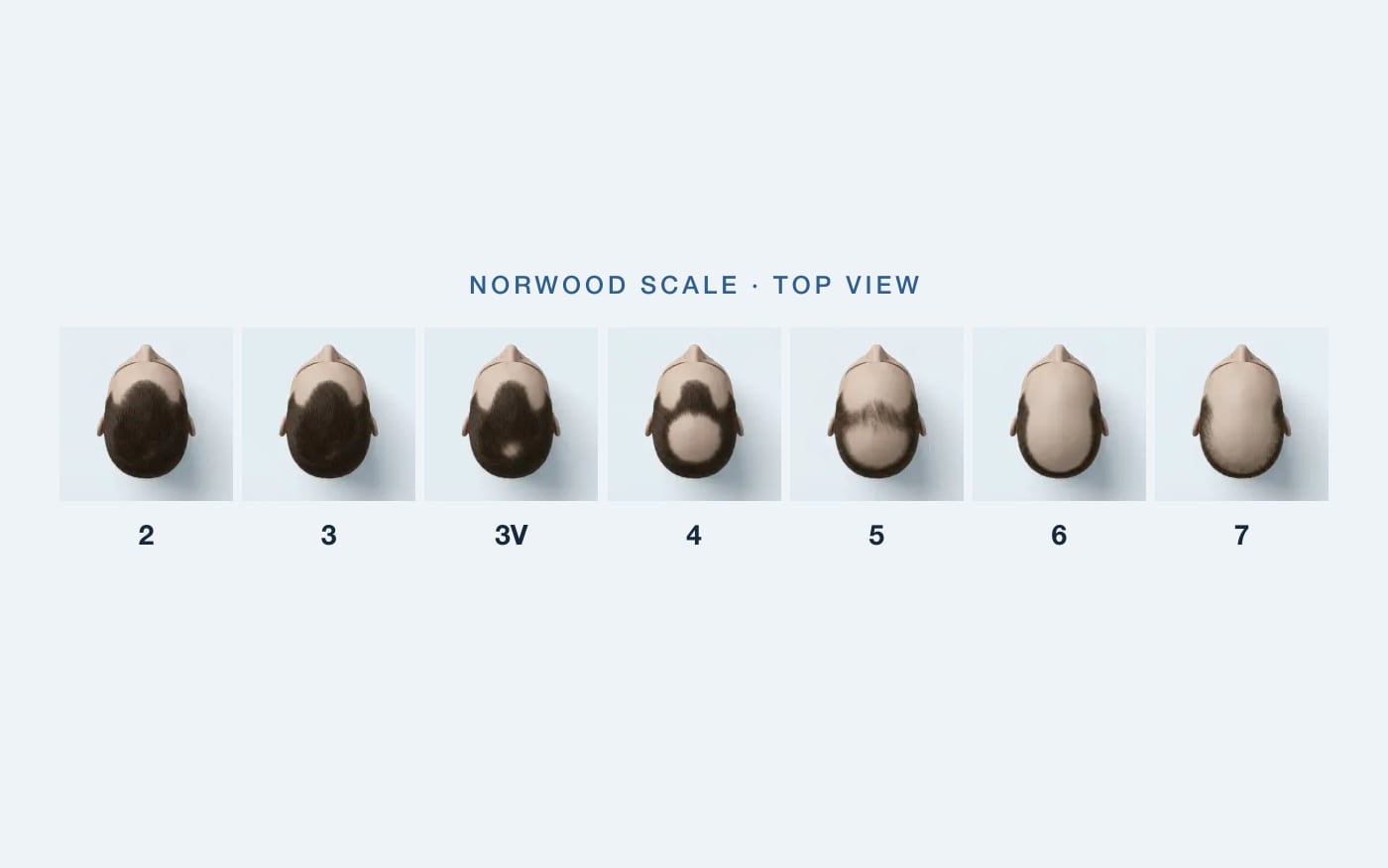 Norwood scale stages from 2 to 7, top view