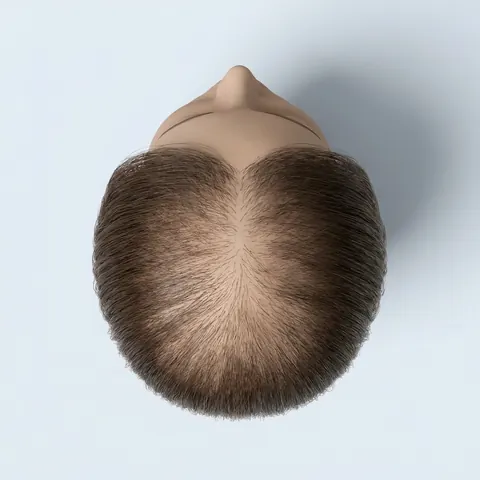 Top view: moderate thinning hair loss