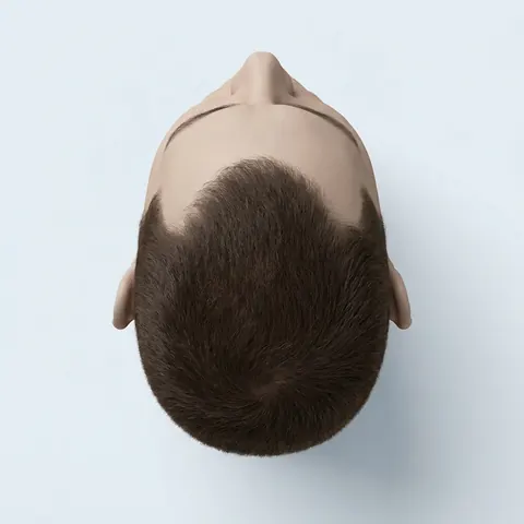 Top view: stage 2 hair loss