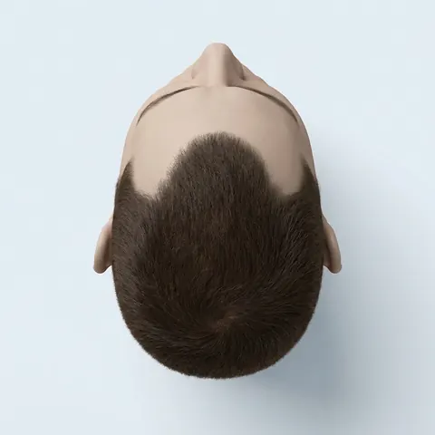 Top view: stage 3 hair loss