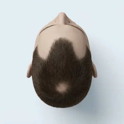 Top view: stage 3 vertex hair loss