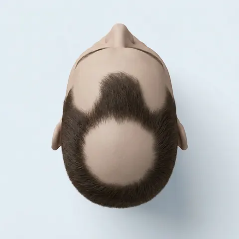 Top view: stage 4 hair loss