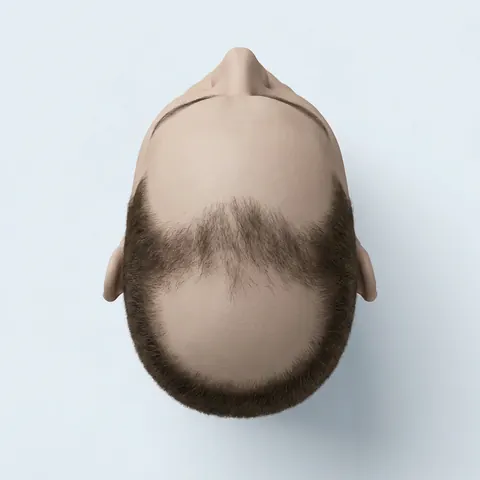 Top view: stage 5 hair loss