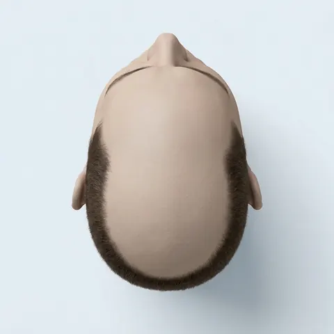 Top view: stage 6 hair loss
