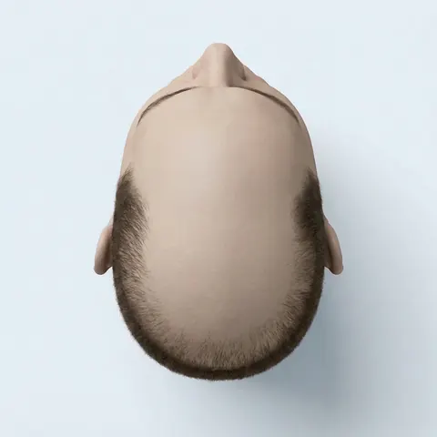 Top view: stage 7 hair loss