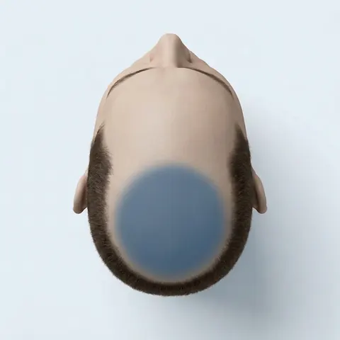 Top view of the head with the crown highlighted