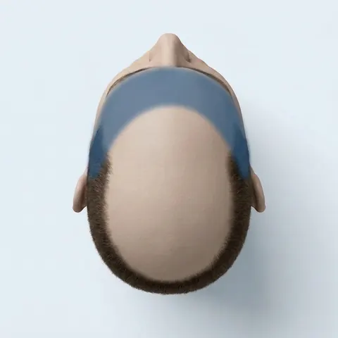 Top view of the head with the hairline and temples highlighted