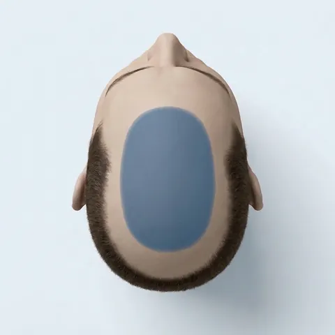 Top view of the head with the mid-scalp highlighted