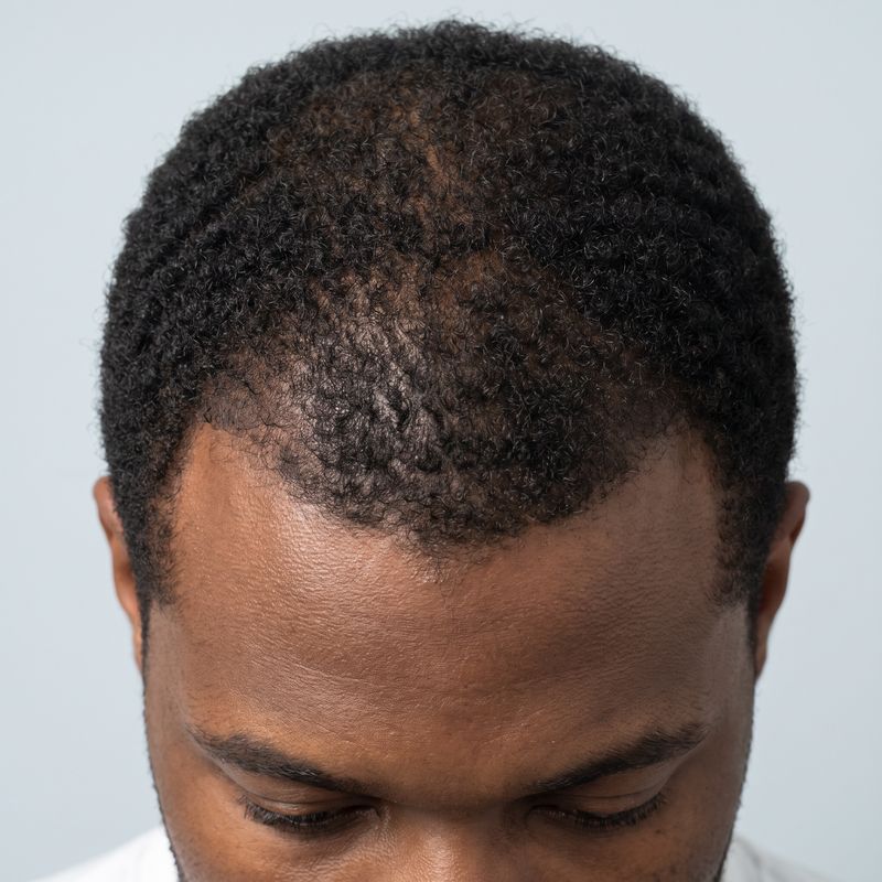Mid-scalp thinning