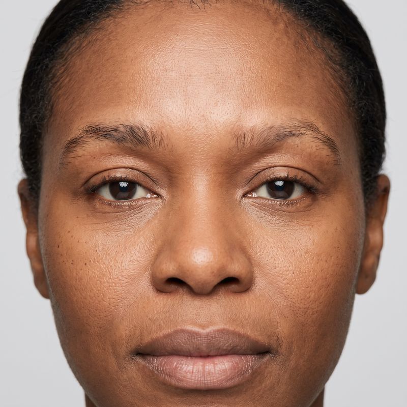 Mid-scalp thinning