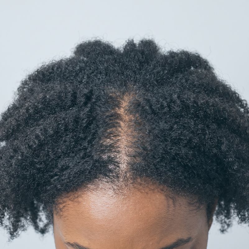 Mid-scalp thinning