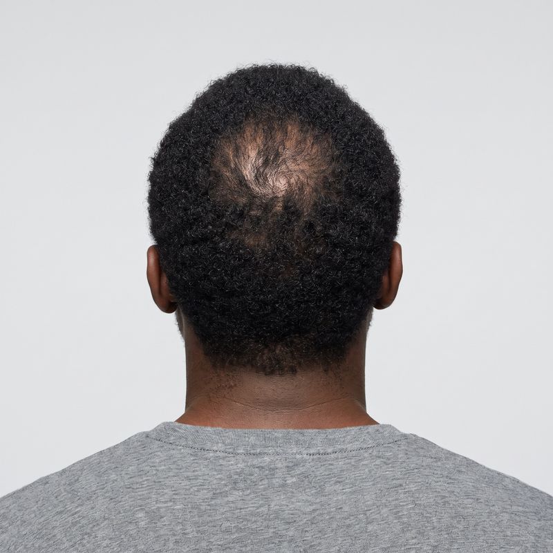 Crown thinning