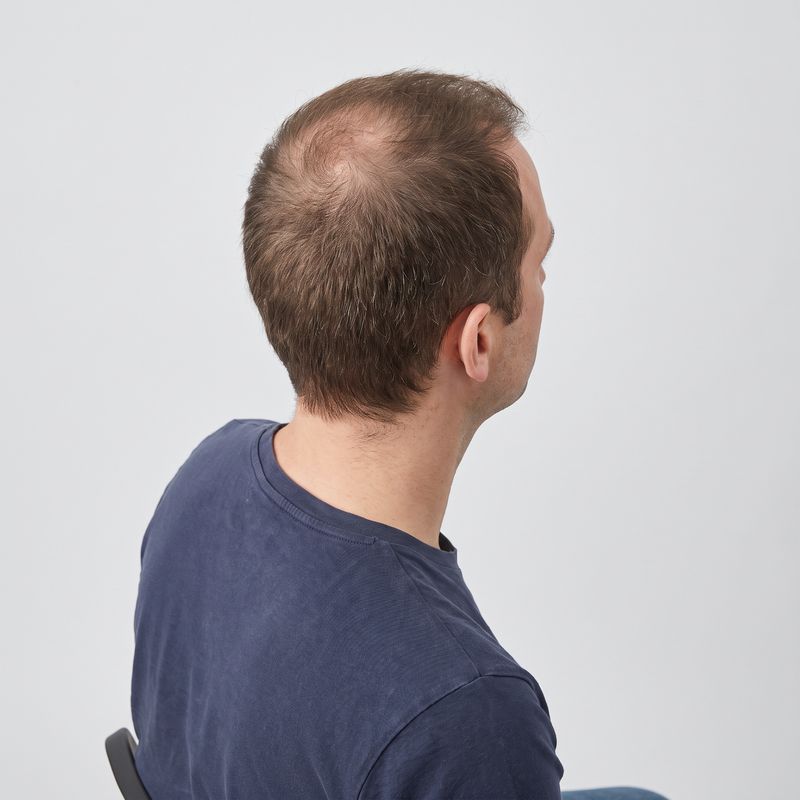 Crown thinning
