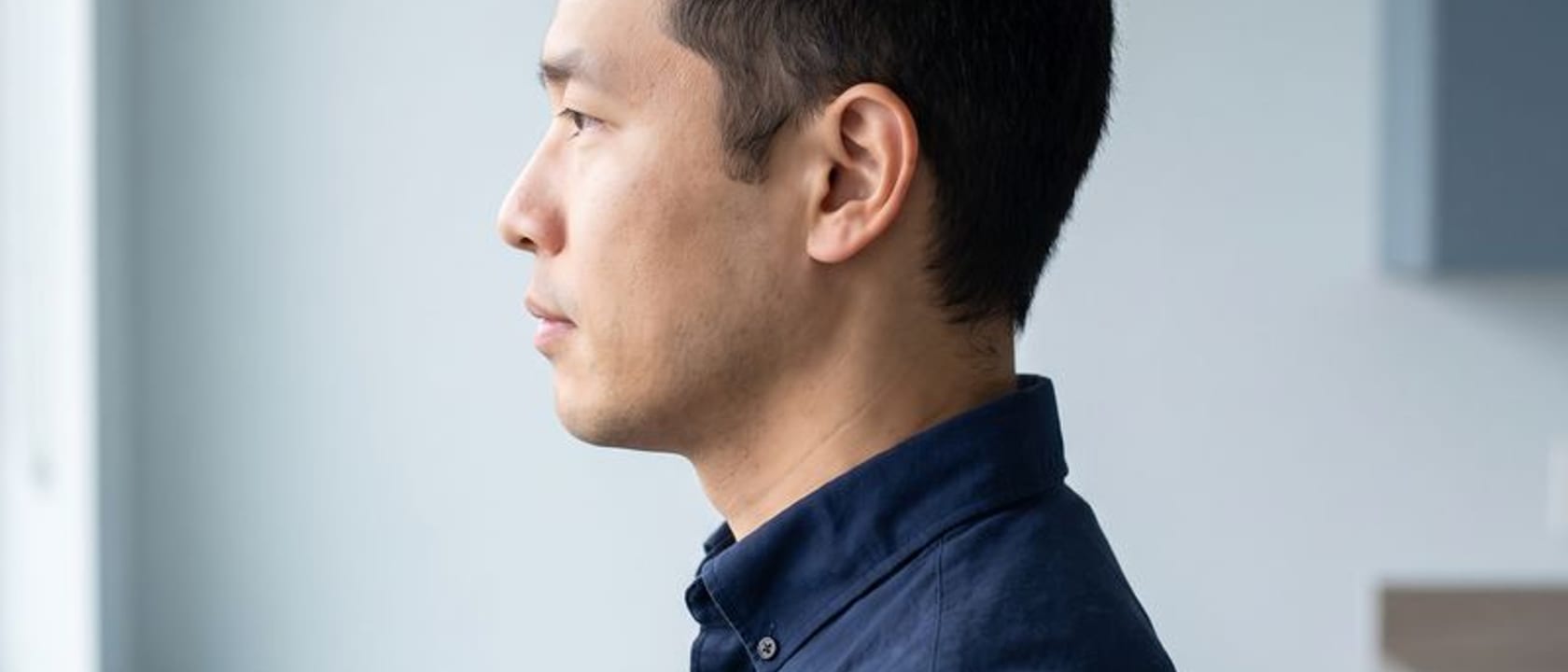 Hair Transplant for a Receding Hairline: Grafts, Design and Cost