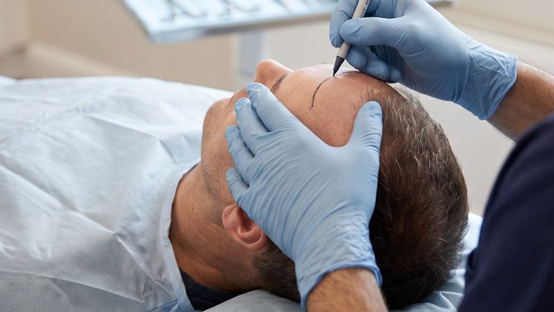 Surgeon drawing a hairline design