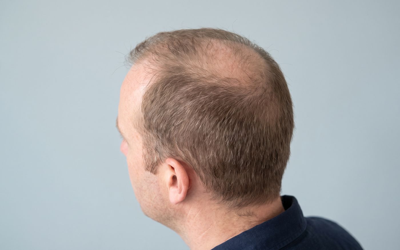 Crown thinning and temple recession shown for hair transplant graft planning