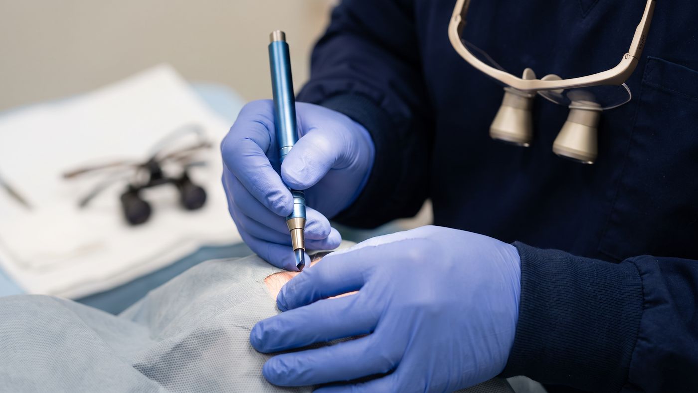 Sapphire FUE channel opening — a technique refined in Turkey's high-volume clinics